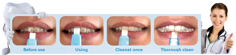 effective home teeth whitening kit  kit efficace de blanchiment des dents à domicile