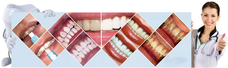 various teeth whitening New Creative Products Dental Whitening with custom logo various teeth whitening New Creative Products Dental Whitening with custom logo