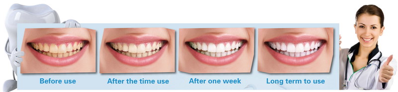 various-teeth-whitening-New-Creative-Products-Dental-Whitening-with-custom-logo blanqueamiento de dientes nuevos-Productos-creativos-Blanqueamiento dental con logotipo personalizado