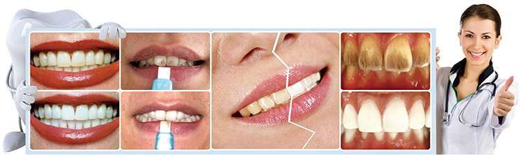 How to remove plaque and tartar Best home treatments lfsponge-teeth-clean-kit-remove-plaque-and-tartar-Best-home-treatments