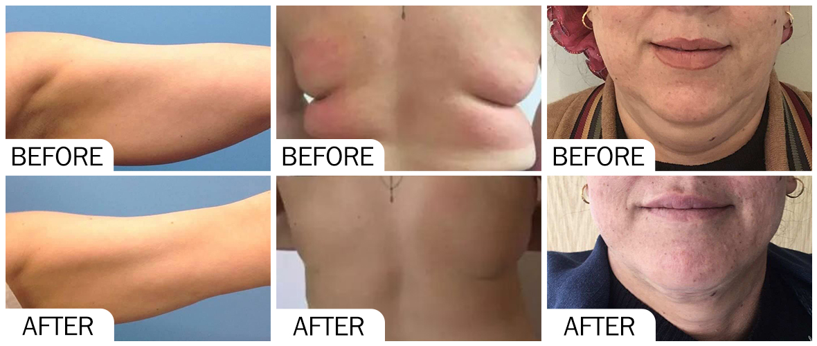 Before and After Fat Dissolving Solution 溶脂液前后对比