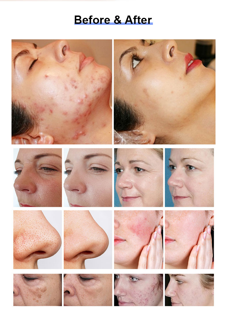 Thulium Laser
