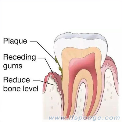 Tartar--tea-stains-and-smoking-stains--builtup--more-details-on--lfsponge.com