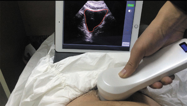 MD6000 China Top Quality 4D Scanner à vessie sans fil