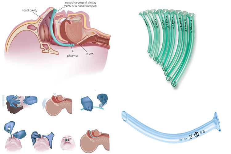 Nasopharyngeal Airway