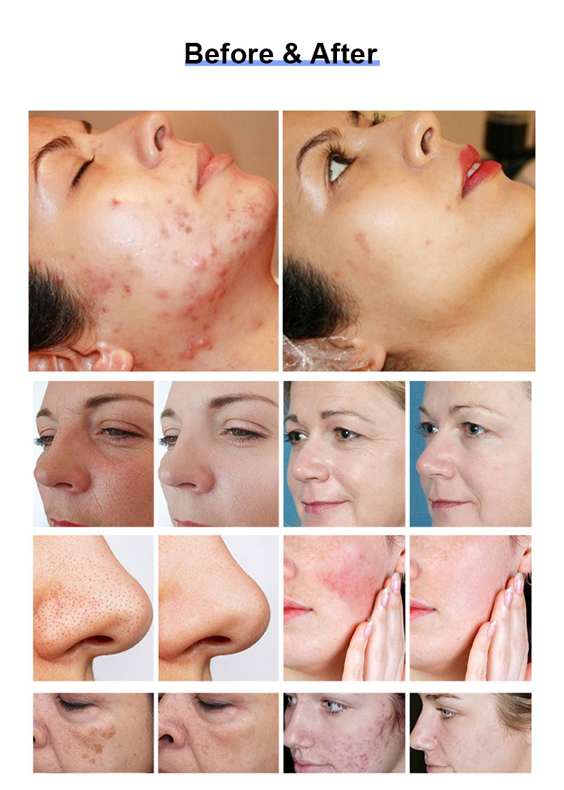 Thulium -Laser