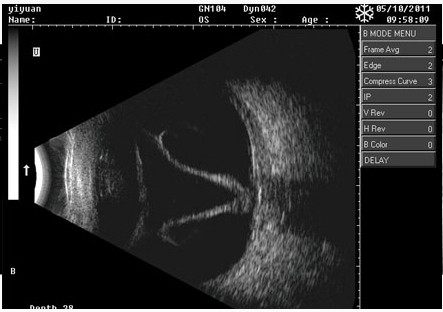 CAS-2000C China Top Calidad Oftálmica portátil AB Scan