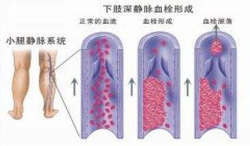 Deep vein thrombus .jpg