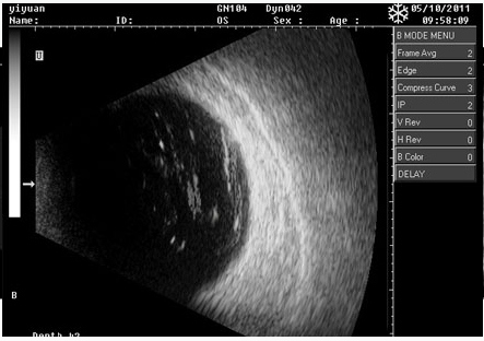 CAS-2000C China Top Calidad Oftálmica portátil AB Scan