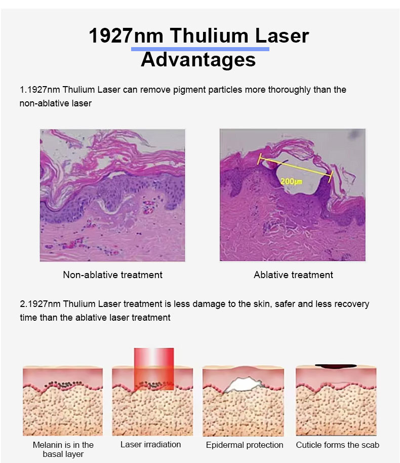 Thulium Laser