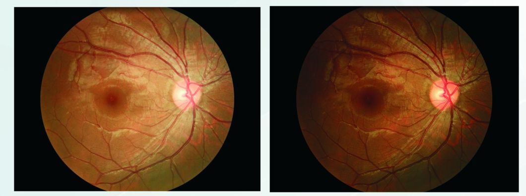 Reticam 3100 Cámara retinal oftálmica de alta calidad con equipamiento de China