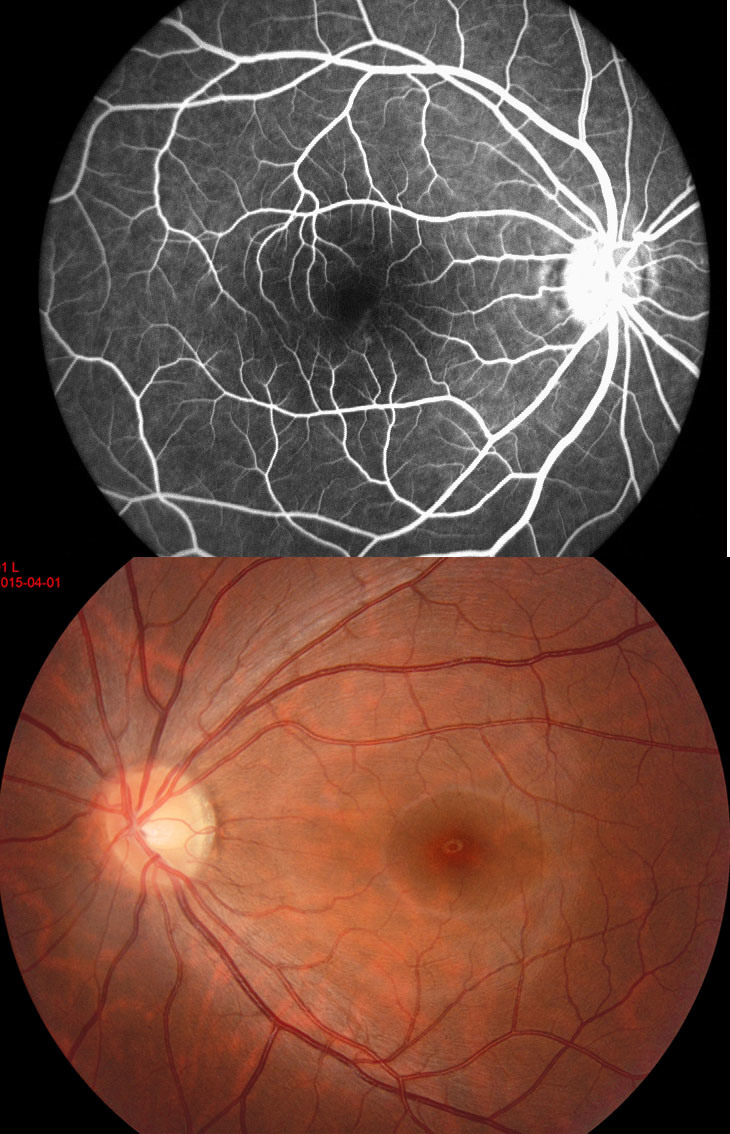 Appareil-photo non mydriatique de fundus d'équipement ophtalmique d'Aps-B Chine avec la fonction d'angiographie de fluorescéine