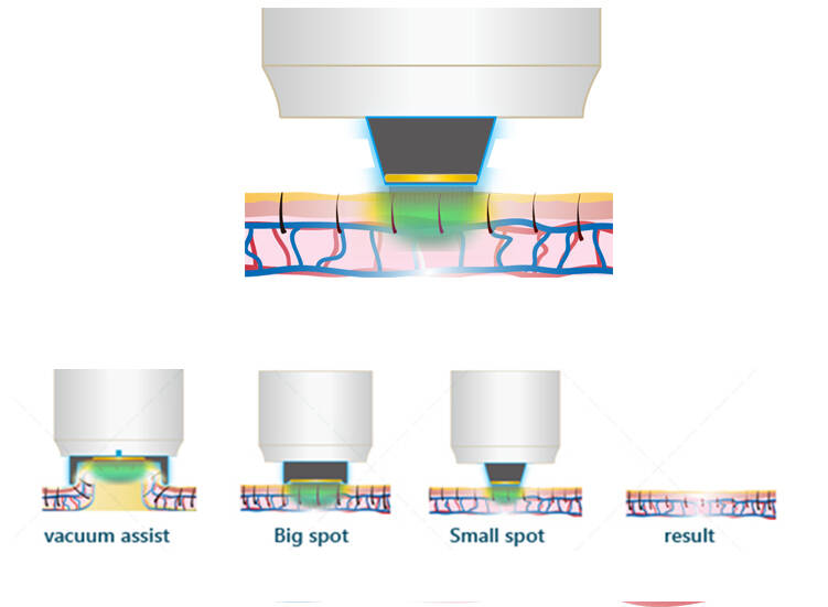 Alexandrite-Laser-Haar-Removal-Maschine