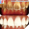 Kit de limpieza de dientes avanzado LF005