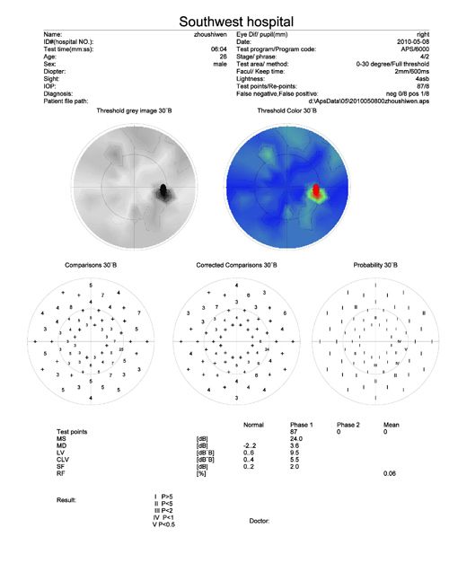 Analyseur de champ visuel d'équipement ophtalique de qualité supérieure de Chine (APS-6000B)