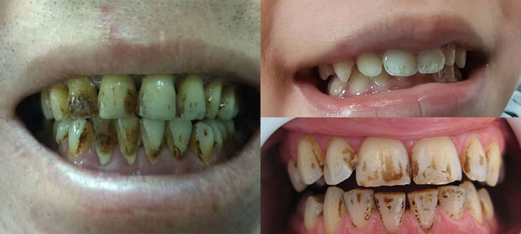 teeth stained by cigarette smoke or noticeable tartar see immediate results