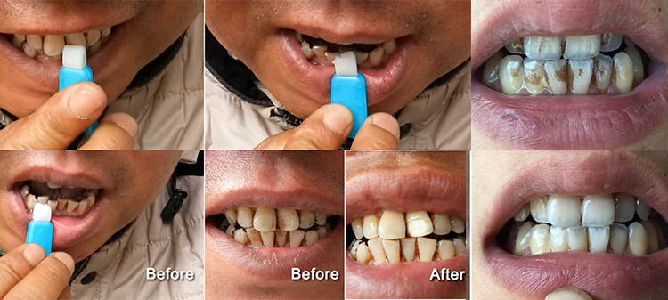 the purpose of teeth cleaning kit is to clean teeth and remove tartar