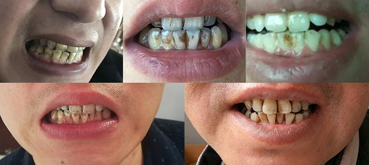 D&eacute;finir des attentes r&eacute;alistes lors de l’utilisation d’un kit de nettoyage des dents