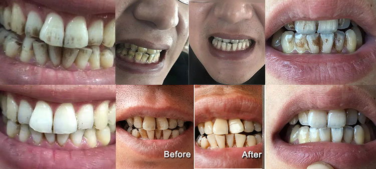 Kit de nettoyage des dents Efficacit&eacute; contre la plaque externe