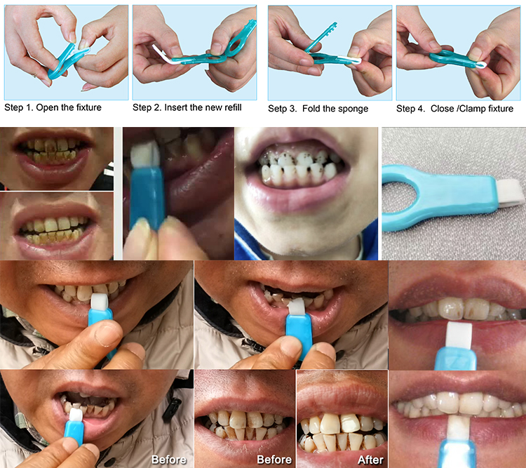 Teeth-Cleaning-Kit-Melamine-cleaning-srtips-Replacement-Guide-3