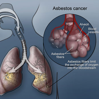 asbestos-cancer.jpg