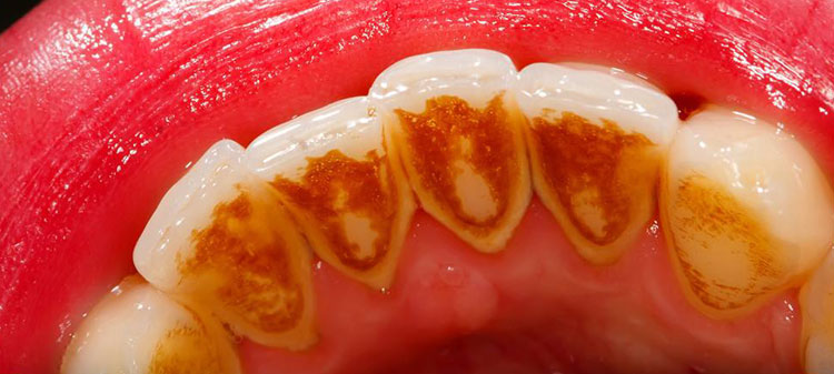  penetrated the enamel tartar not effective