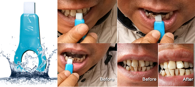 the Power of Teeth Cleaning Kit effectiveness in removing tartar