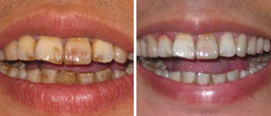 teeth clean kit Noticeable cleaning and whitening results for Heavy stains