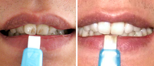 teeth clean kit Quick results for Smok stained teeth