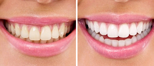 teeth clean kit Lighter and brighten results for Yellow teeth 