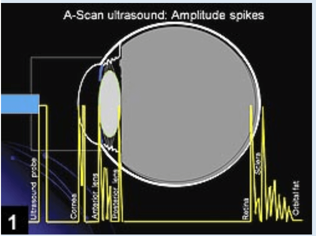 Biometr&iacute;a de ecograf&iacute;a A-Scan